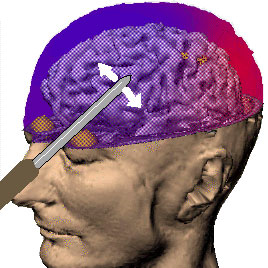 lobotomy procedure