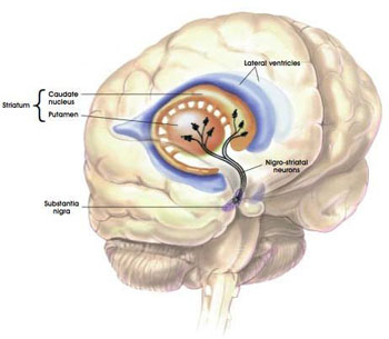 Parkinsons Disease